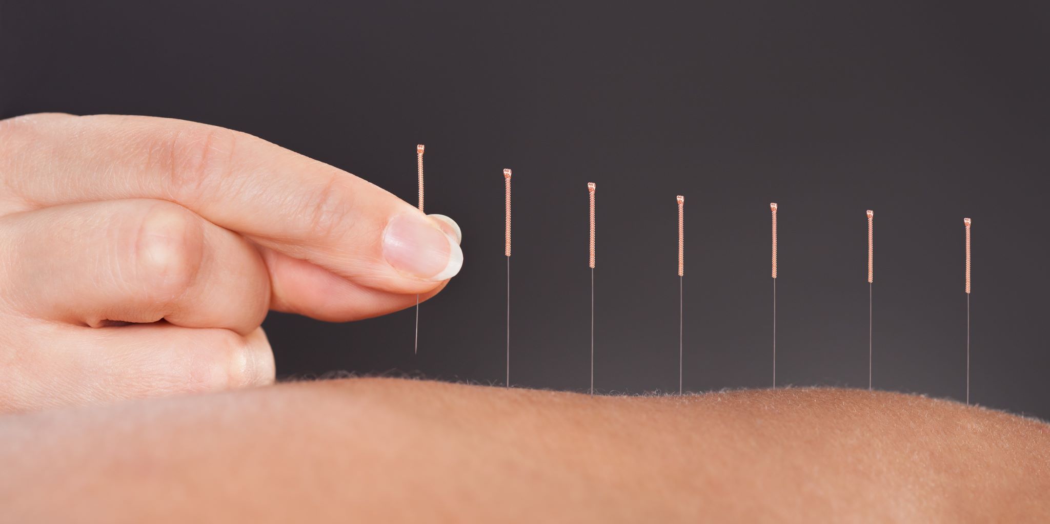 Acupuncture A Healing and Wellness Journey